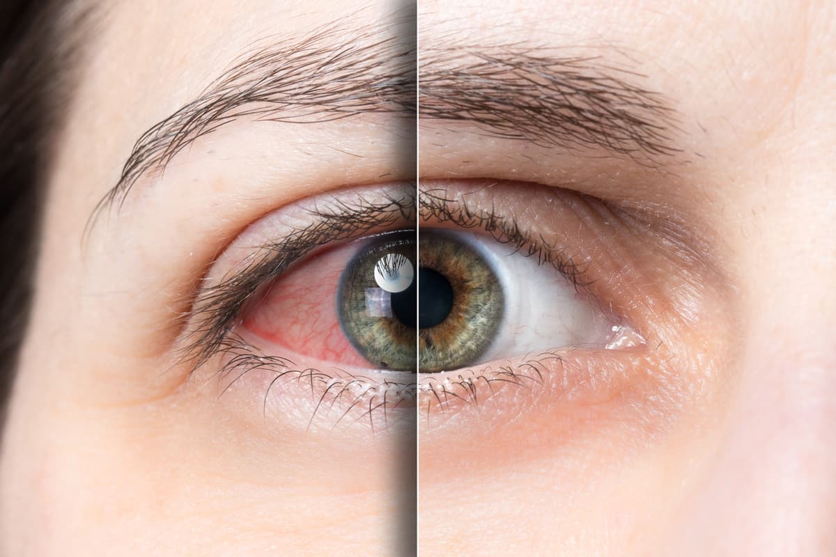 Understanding Glaucoma: The Silent Thief of Sight