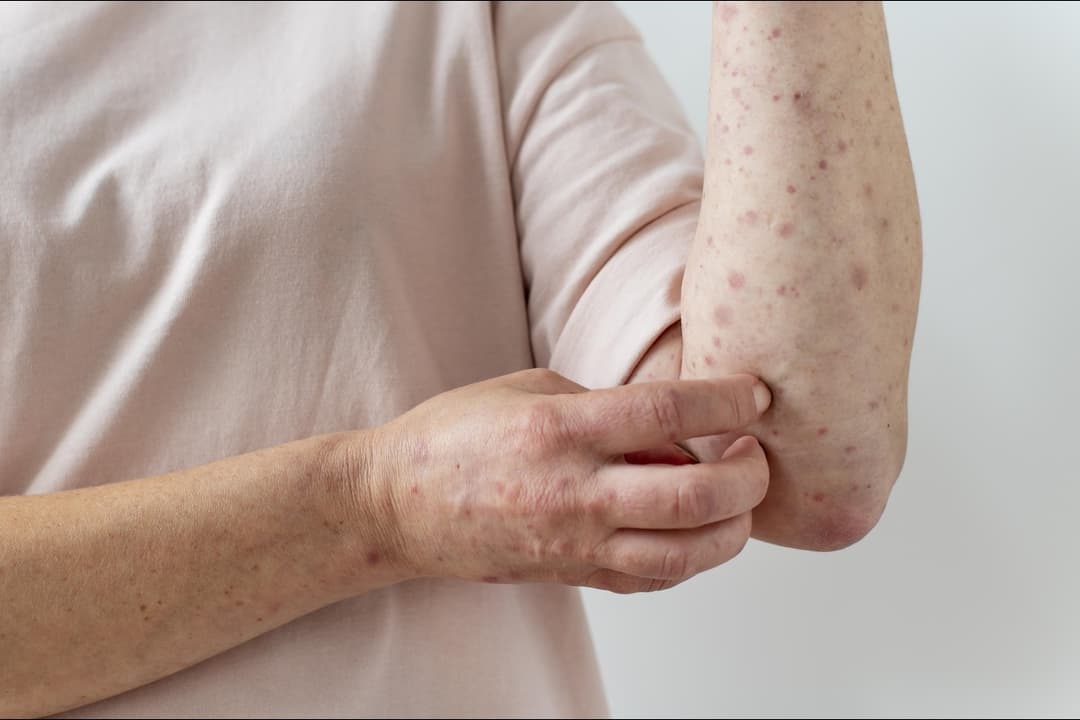 Measles: Symptoms, Treatment &amp; Prevention