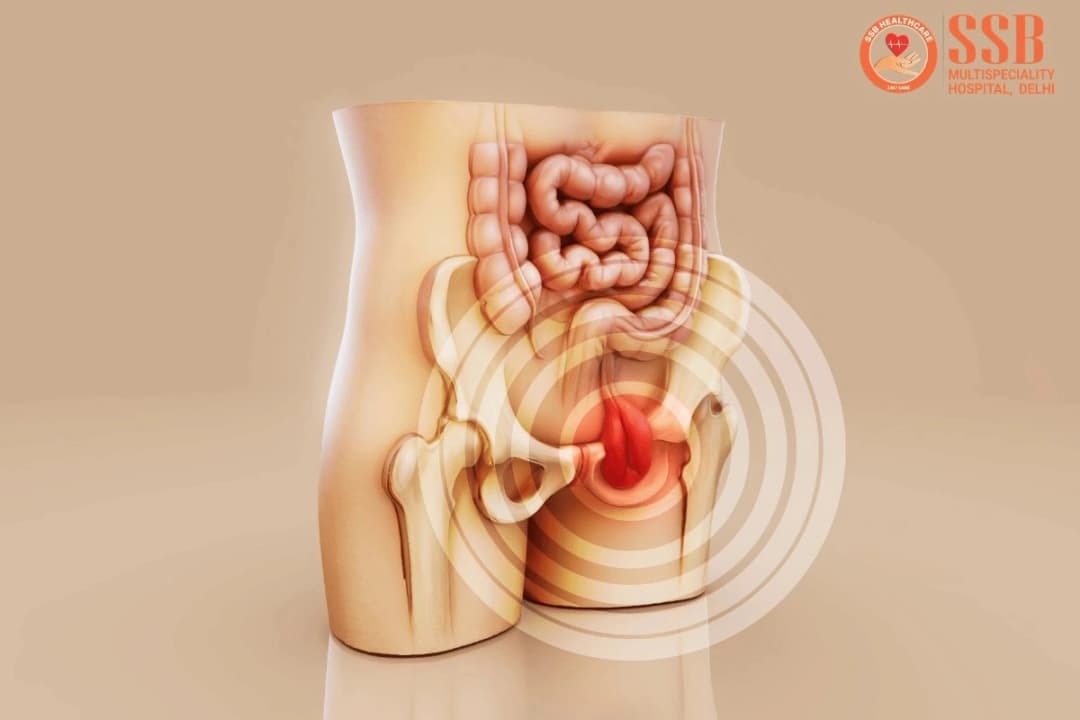 Hernia surgery in Delhi: when watchful waiting is no longer enough